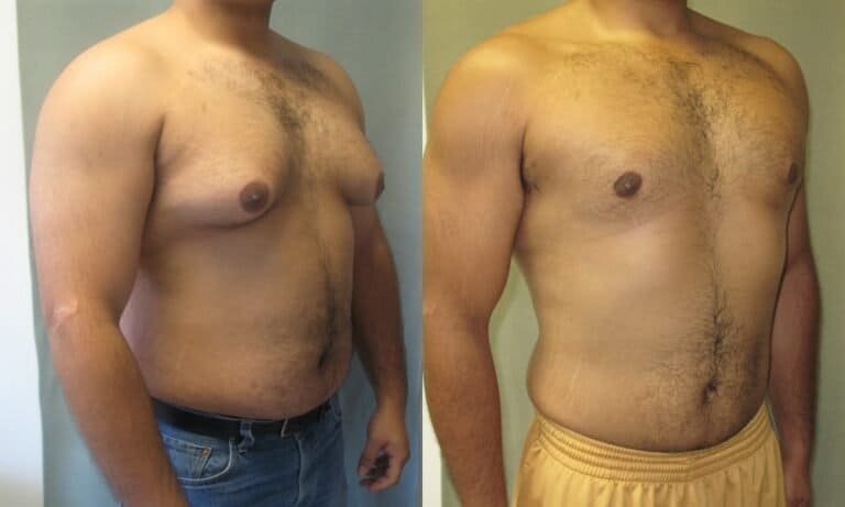 Gynecomastia